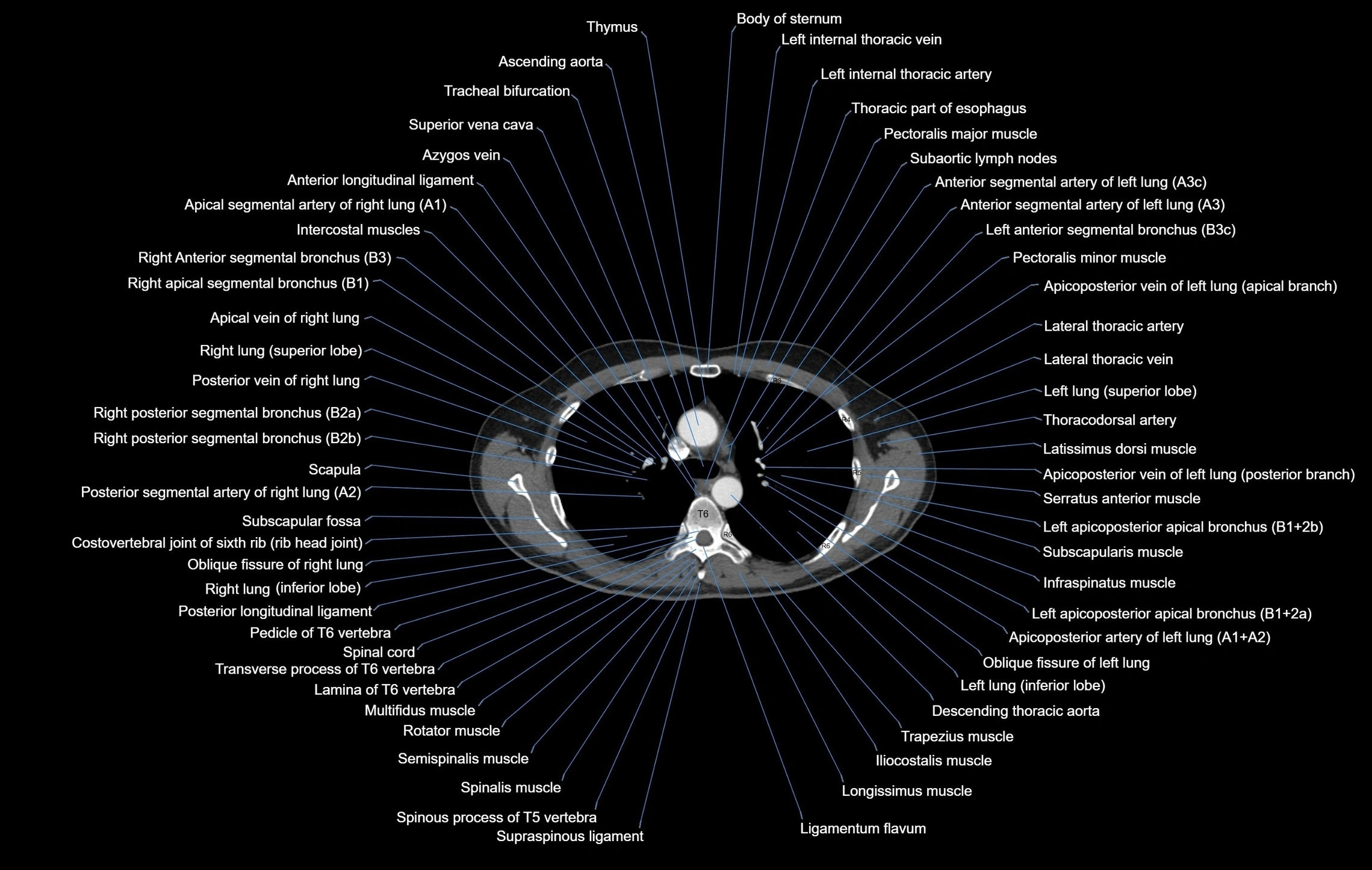 CT chest (thorax) labelled axial cross sectional anatomy radiology image-00046.webp